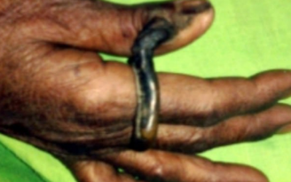 Chiếc sừng kỳ lạ dài 6 cm mọc ra từ ngón tay người phụ nữ