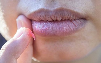 Tưởng mụn trên môi, bàng hoàng khi biết đó là... ung thư da