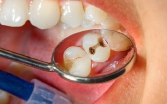 Làm sao để giúp răng mau phục hồi khi bị sâu, viêm nướu?