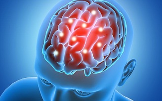 Bị đau đầu, người phụ nữ sốc khi biết mình mắc đến 16 khối u não