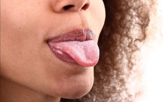 Bỗng dưng xuất hiện cục u trên lưỡi, có phải ung thư miệng?