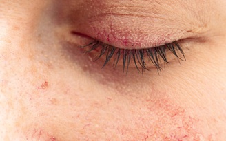 Bệnh lạ: Cô gái cứ ra nắng là da bị tổn thương không thể phục hồi