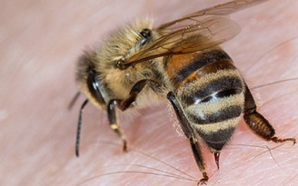 Người phụ nữ bị ong đốt hơn 400 vết, bác sĩ phải gỡ từng vòi chích