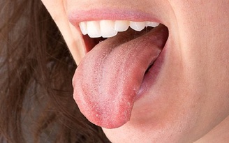 Chuyện lạ: Lưỡi của người phụ nữ bỗng... mọc lông