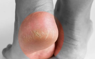 Nứt gót chân kéo dài cảnh báo bất ổn gì ở cơ thể?