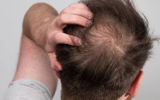 Viêm nang lông ở da đầu, làm sao để trị?