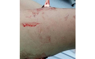 Một người bị kẻ lạ đâm xuyên đùi