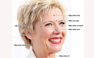 Xóa nhăn bằng Botox và Filler - phương pháp nào tốt hơn?