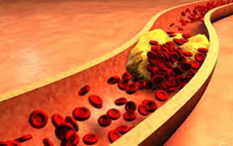 Cholesterol cao, coi chừng mắc bệnh tim và viêm xương khớp