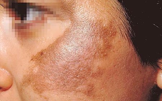 Nguyên nhân hình thành nám mảng và cách chữa trị hiệu quả - Tư vấn chuyên gia