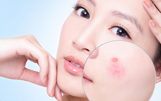 Mụn trứng cá - Dùng kem trị mụn của hãng nào hiệu quả?