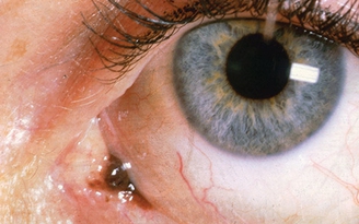 Ung thư mắt: Nhìn thấy những chấm trắng nhấp nháy, đến ngay bác sĩ