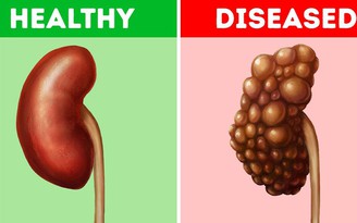 Những thói quen này có thể hại thận của bạn