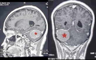 Đau đầu 3 tháng không khỏi, không ngờ bị u màng não hiếm gặp