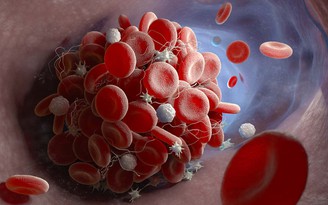 Phát hiện mới: Người mắc Covid-19 có nguy cơ phát triển các cục máu đông