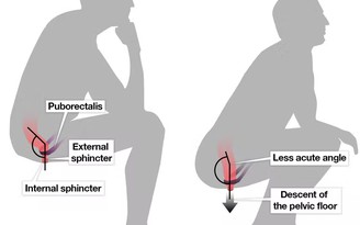 Đi vệ sinh: Ngồi xổm hay ngồi trên bệ tốt cho sức khỏe hơn?