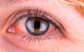 5 nguyên nhân phổ biến khiến bạn bị mắt đỏ