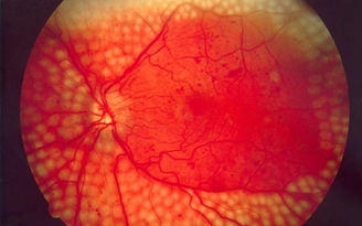 Google muốn sử dụng trí tuệ nhân tạo chữa trị bệnh về mắt