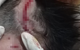 Bé trai 4 tuổi ở Hà Tĩnh bị chó becgie nhà nuôi tấn công