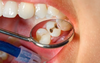 Sẽ thế nào nếu sâu răng không được điều trị?