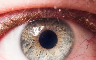 Triệu chứng hiếm gặp ở mắt liên quan Covid-19