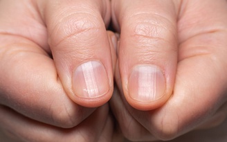 Ngày mới với tin tức sức khỏe: Nhìn móng tay có thể đoán bệnh gan, ung thư