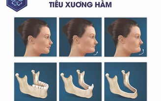 Tại sao không nên trì hoãn trồng răng implant?