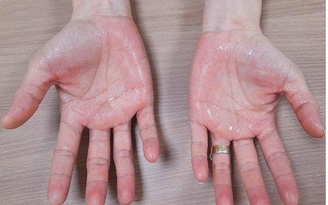 Ngồi máy lạnh cũng ra mồ hôi như tắm là bệnh gì? Ngồi máy lạnh cũng ra mồ hôi như tắm là bệnh gì?