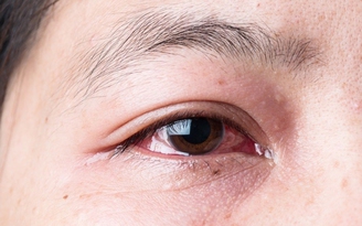Bảo vệ mắt đúng cách trước dịch đau mắt đỏ