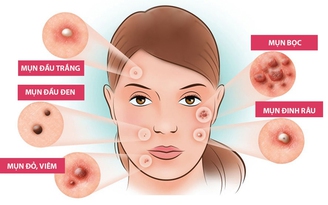 Vì sao mụn hay tái phát, khó trị dứt điểm?