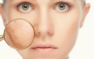 Bí quyết giúp giảm nám đến 90%