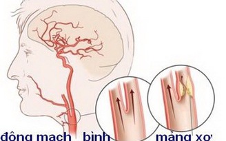 Can thiệp đặt stent trong điều trị xơ vữa động mạch