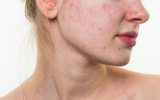 Làm thế nào để trị hết mụn do nội tiết tố?