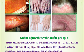 Bệnh vảy nến: Hiểu rõ để điều trị cho tốt