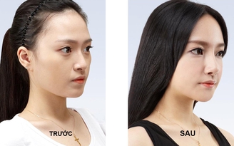 Phương pháp nâng mũi tái phẫu thuật nào được lựa chọn hiện nay?