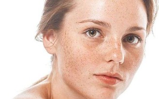 Tăng sắc tố da: Nguyên nhân, biểu hiện và cách điều trị hiệu quả