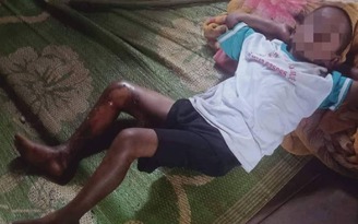 Đắk Lắk: Xác minh vụ bé trai 8 tuổi bị nam thanh niên tẩm xăng đốt