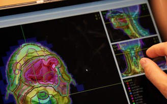 AI vạch liệu trình xạ trị cho bệnh nhân ung thư trong 20 phút