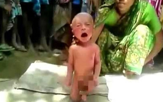 Sốc với màn phơi nắng chữa bệnh