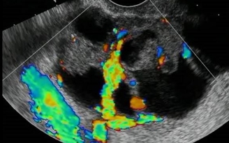 Siêu âm phát hiện ung thư buồng trứng tốt hơn MRI?
