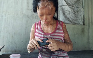 Bi kịch người lớn đánh ghen tạt axít: Cảnh mù lòa đau đớn của con trẻ