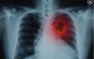 Đi khám khối u, hóa ra là món đồ chơi 'chui' vào phổi 40 năm trước