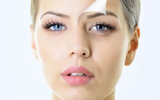 6 điều bạn nên cân nhắc trước khi tiêm Botox
