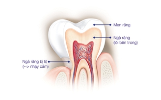 Tiễn biệt răng nhạy cảm với giải pháp thật đơn giản!