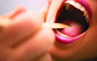 Các vết loét vùng miệng cần phân biệt với ung thư