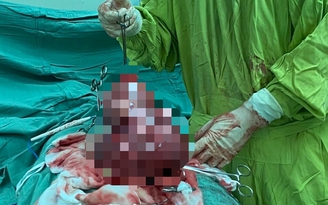Phẫu thuật lấy khối u xơ tử cung 'khủng' 6 kg ra khỏi người bệnh