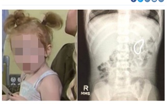 Bé gái 2 tuổi nuốt 28 viên bi nam châm vào bụng