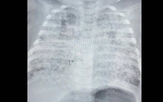 Bé trai 2 tháng tuổi mà phổi trắng xóa do nhiễm lao nặng từ bố