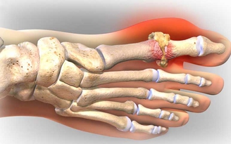 Người mắc bệnh gout có nguy cơ tử vong cao khi bị đau tim