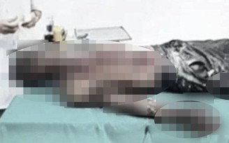 Thái Bình: Nổ bình khí oxy sục bể hải sản, một thợ hàn bị bỏng nặng